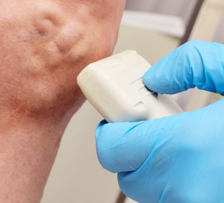 Varicose Vein Removal Manchester