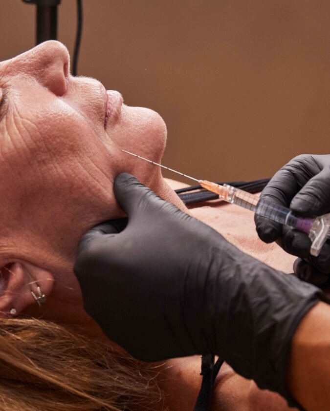 Marionette Lines Filler in Manchester