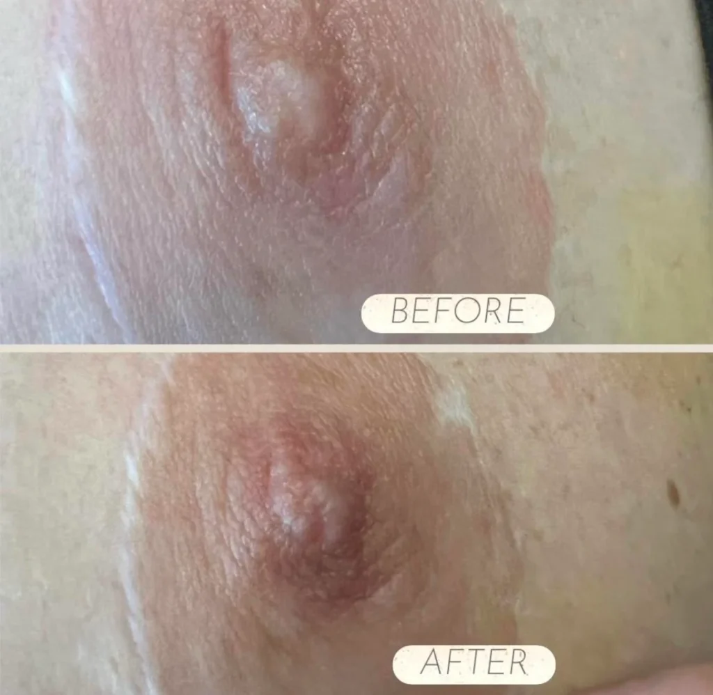 Nipple Filler