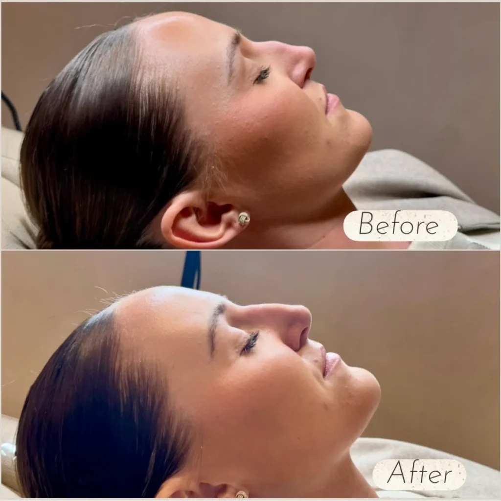 Non Surgical Rhinoplasty