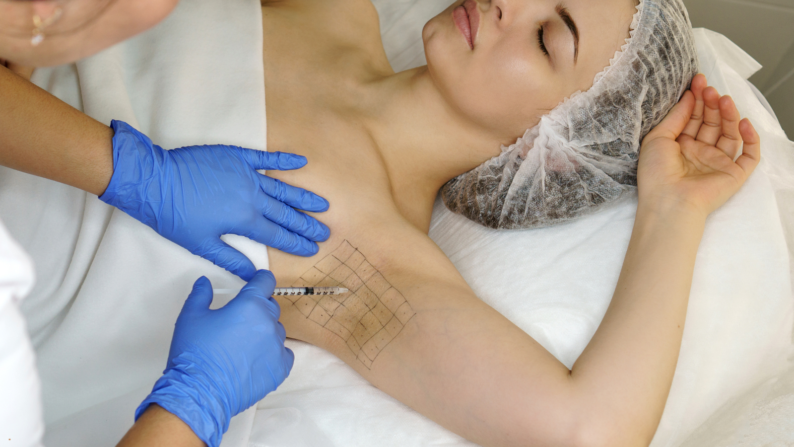 botox underarm sweating treatment in Manchester