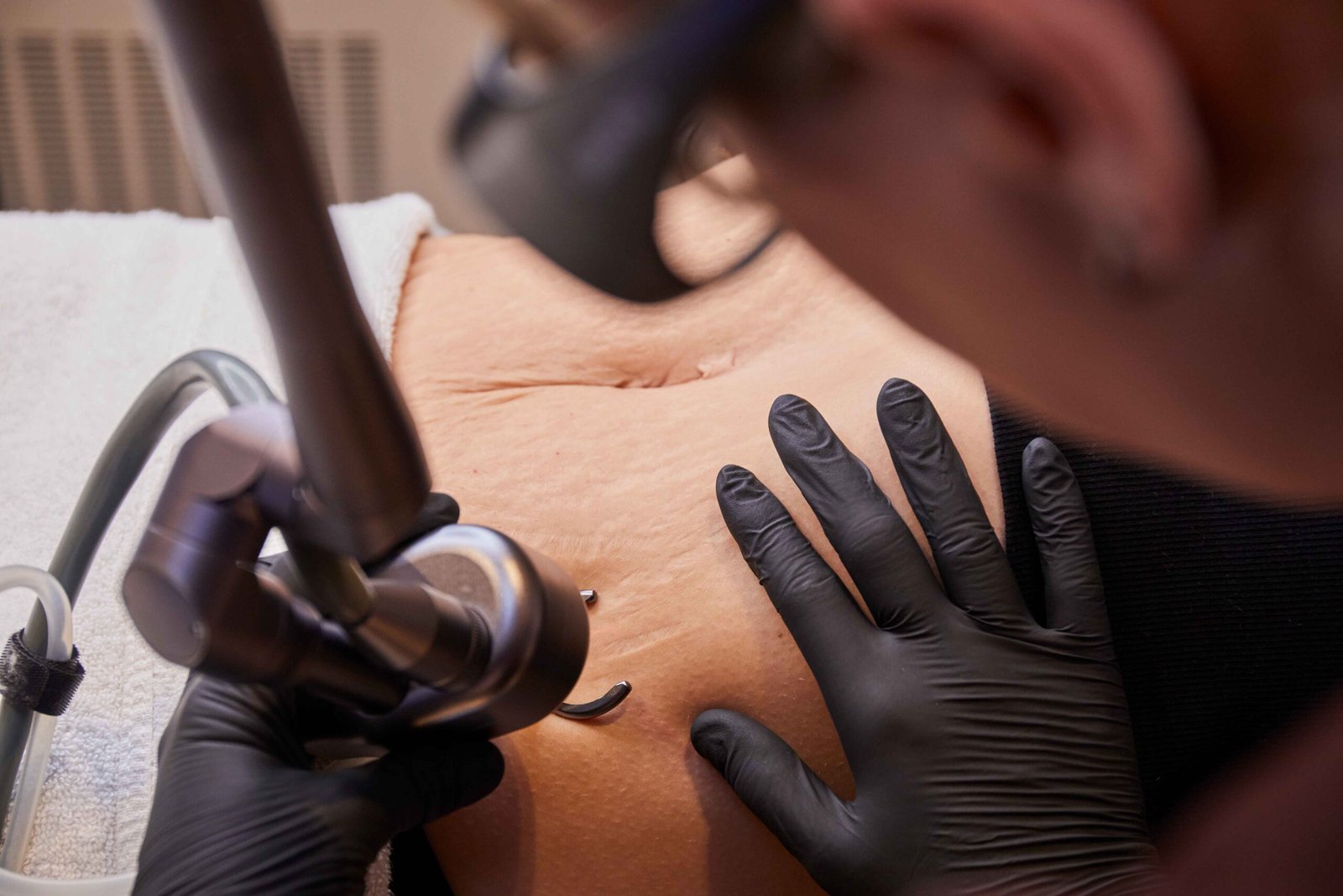 Best CO2 Laser Stretch Mark Removal in Manchester