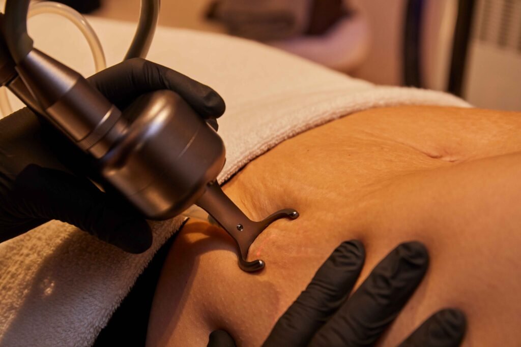 CO2 Laser Stretch Mark Removal in Manchester