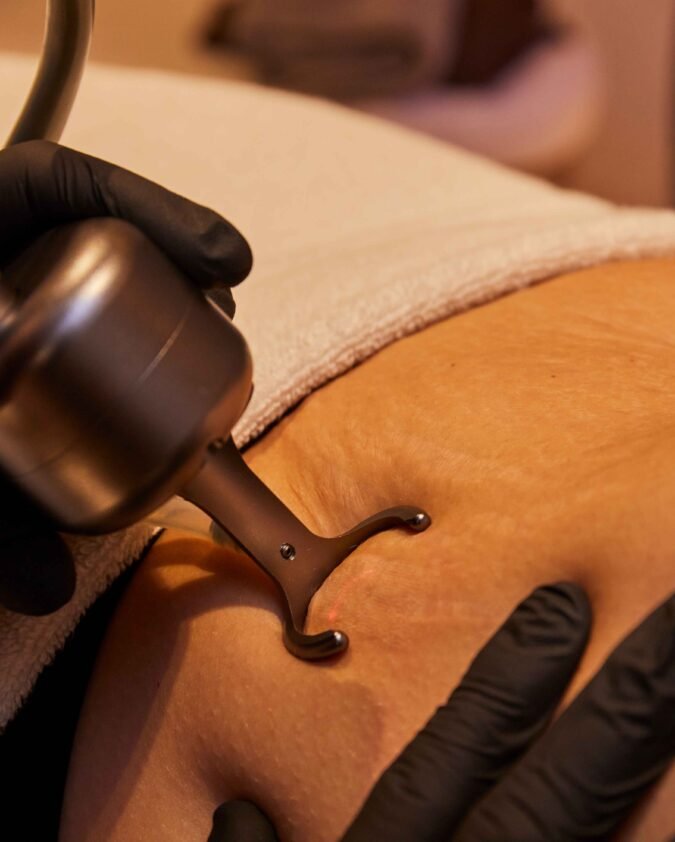 CO2 Laser Stretch Mark Removal in Manchester