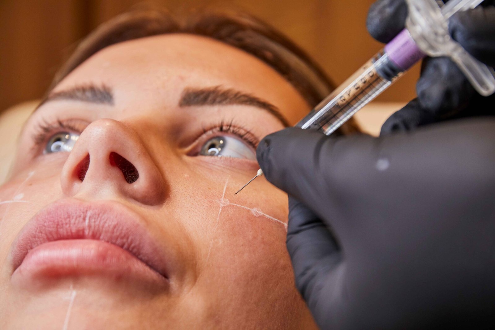 Cheek Augmentation- Filler Manchester