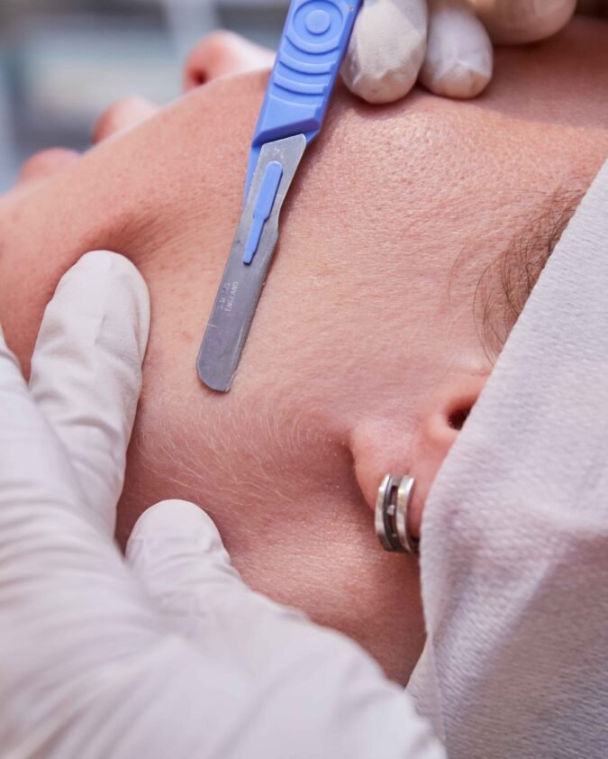 Dermaplaning in Manchester