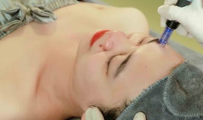 Microdermabrasion