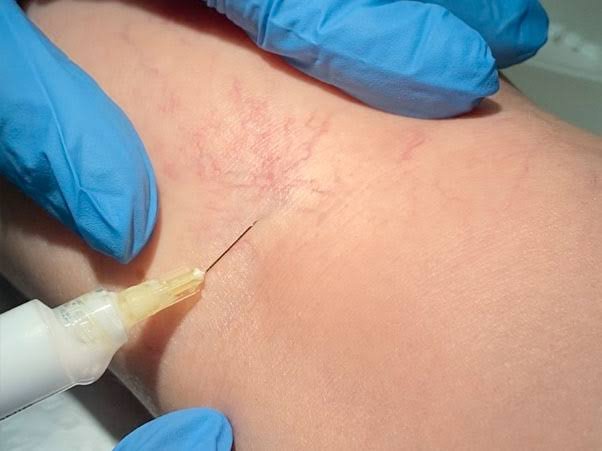 Microsclerotherapy Manchester Aesthetics Clinic