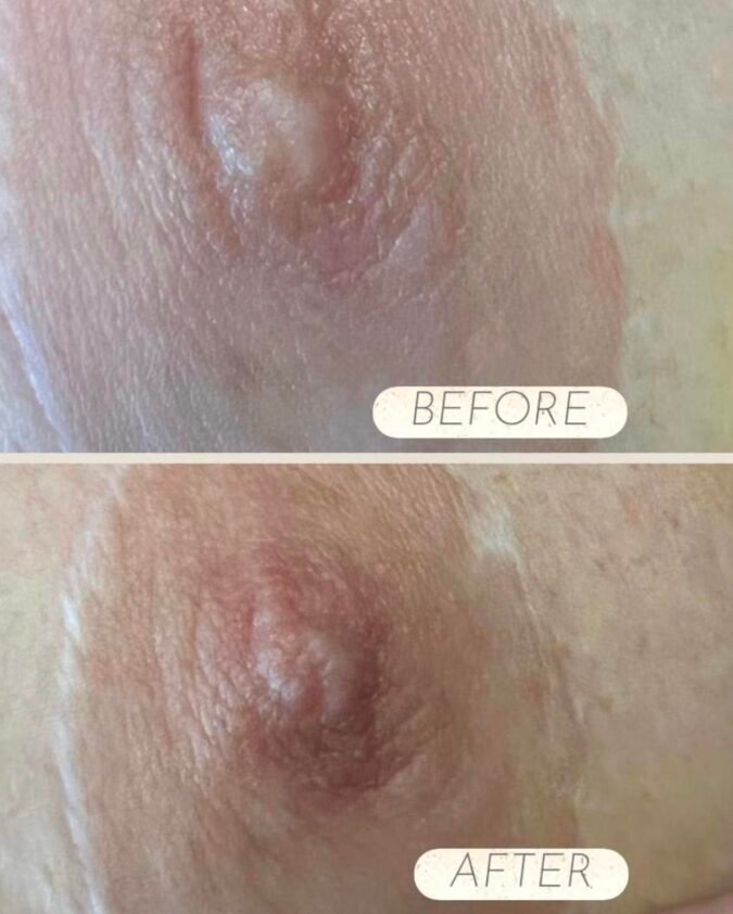 Nipple Filler in Manchester