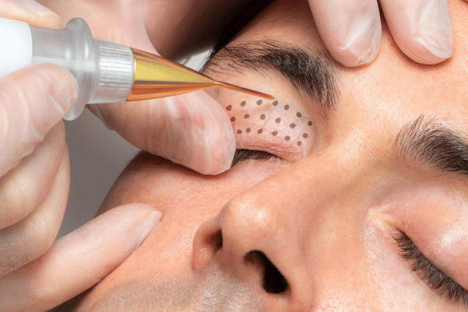 Plasma BT at Manchester Aesthetics Clinic