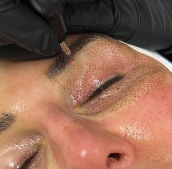 Plasma BT eye lift treatment in Manchester