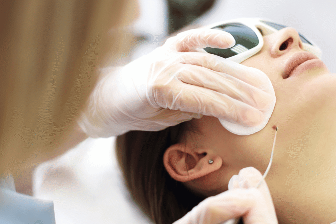 Skin Tag & Wart Removal