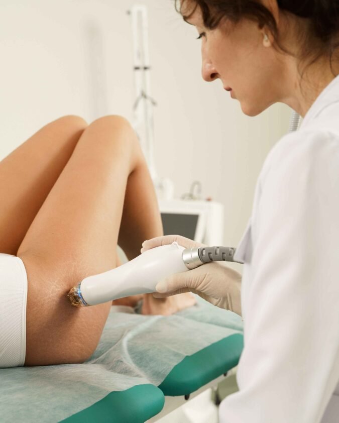 CO2 Stretch Mark Reduction