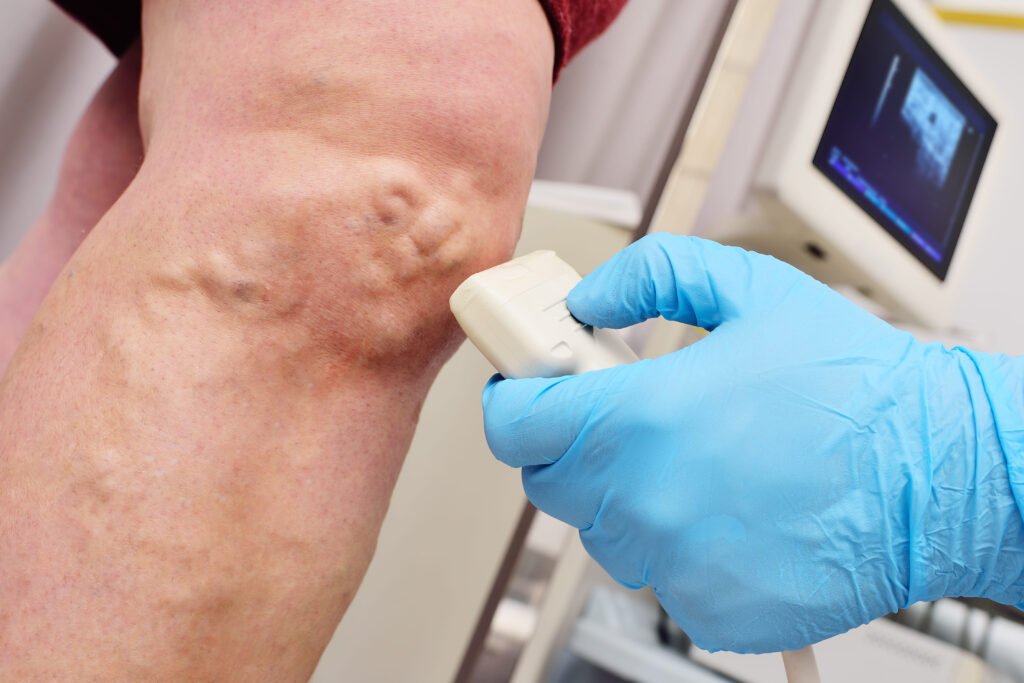 Varicose Vein Removal in Manchester