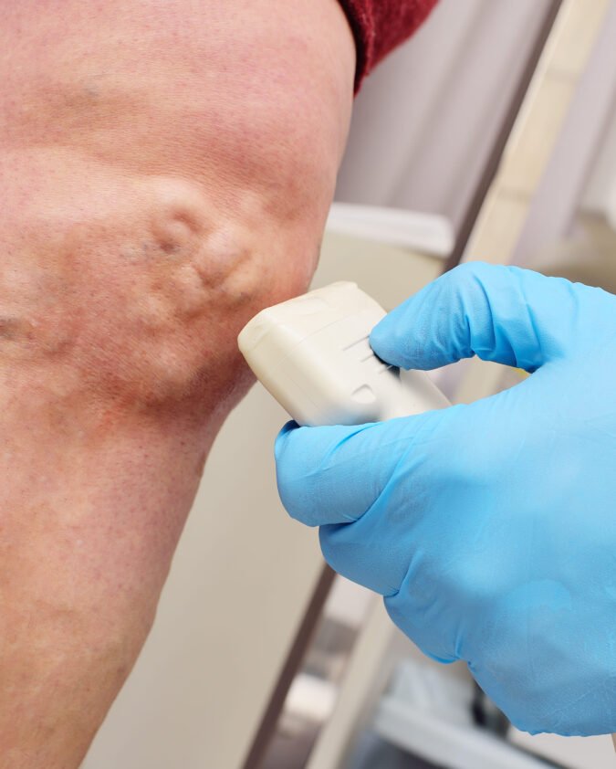 Varicose Vein Removal in Manchester