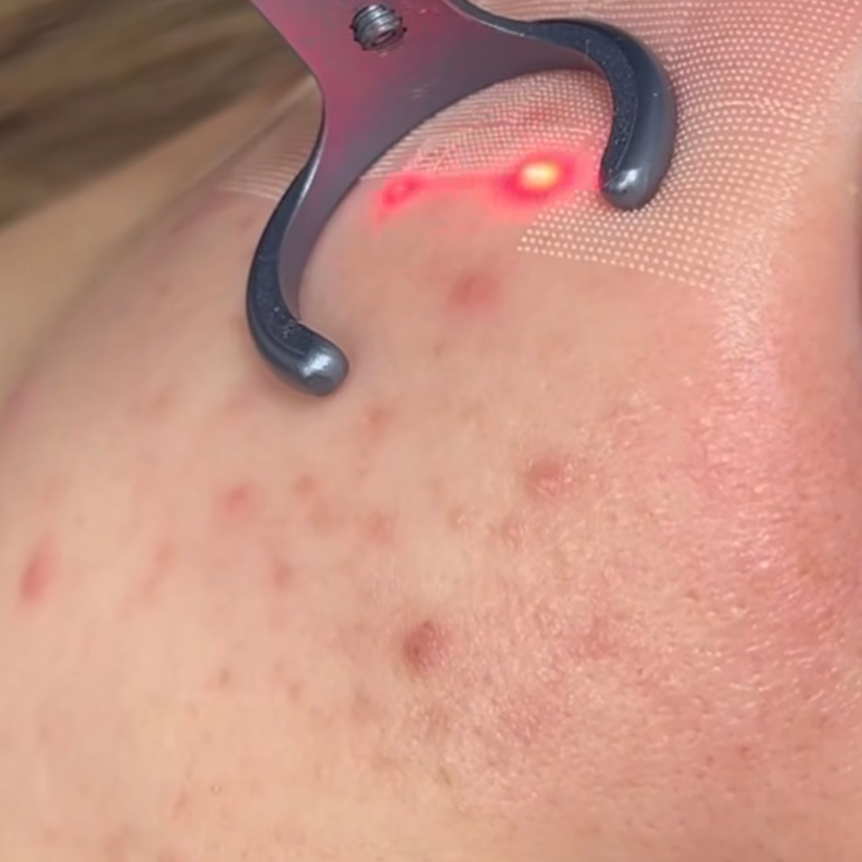 Co2-fractional-laser-Skin-treatment