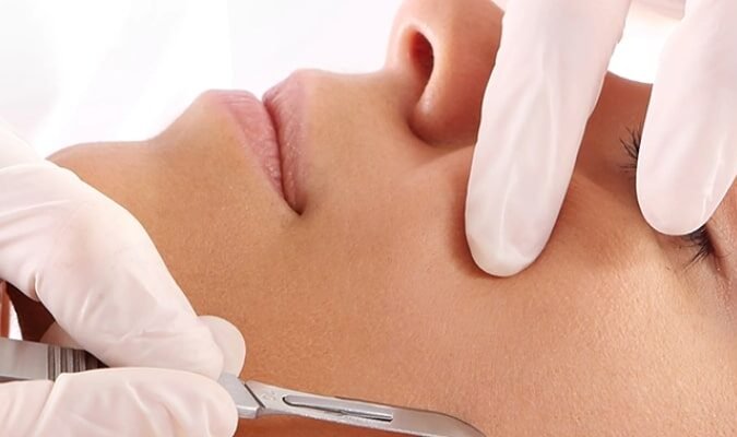 Dermaplaning