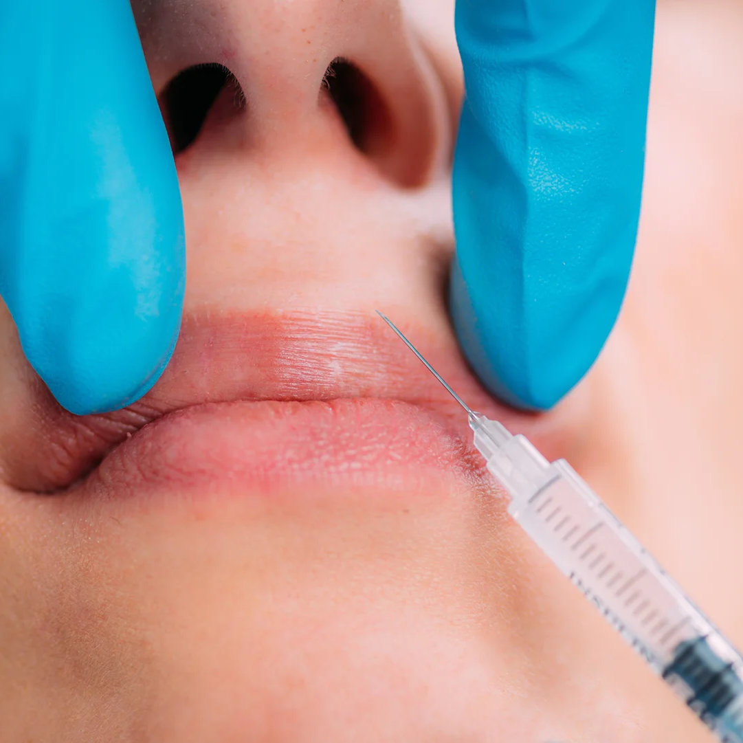 filler_dissolve Treatment in Manchester