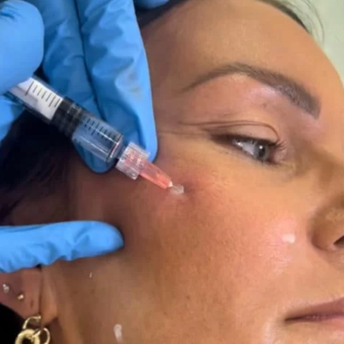 Profhilo Treatment in Manchester