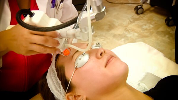 CO2 Facial resurfacing