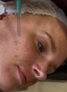 Under eye skin booster injection treatment at Manchester Aesthetics Clinic