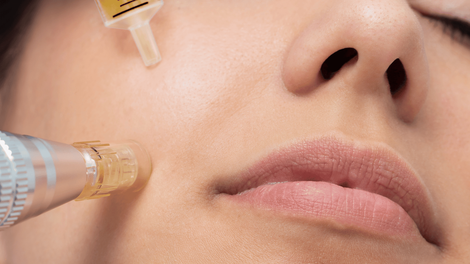 Microneedling Treatment in Manchester
