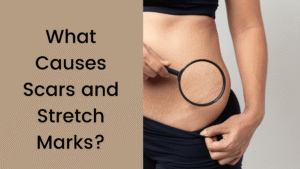Scars and Stretch Marks