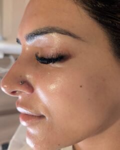 Facial treatment result in Manchester