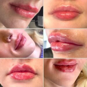 Lip Filler in Manchester