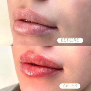 best Lip Filler Results in Manchester