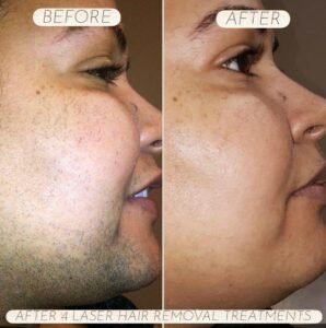 Laser Hair Removal Results in Manchester