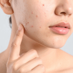 Close-up of facial skin showing acne spots and pigmentation, highlighting concerns treated with laser acne skin treatment in Manchester.