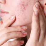 women showing accne scars on her face