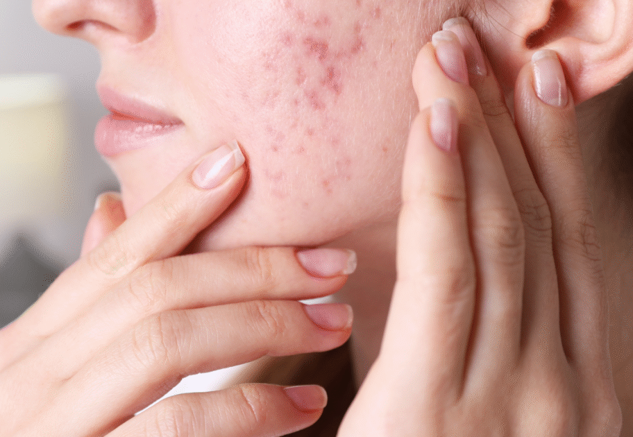 women showing accne scars on her face