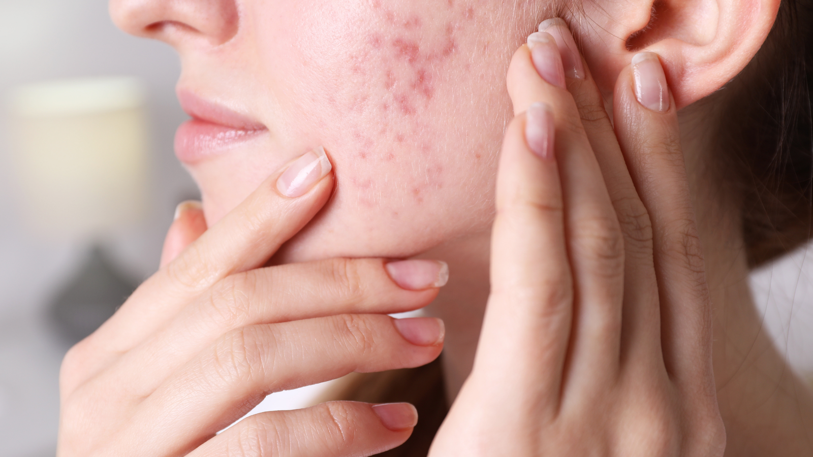 women showing accne scars on her face
