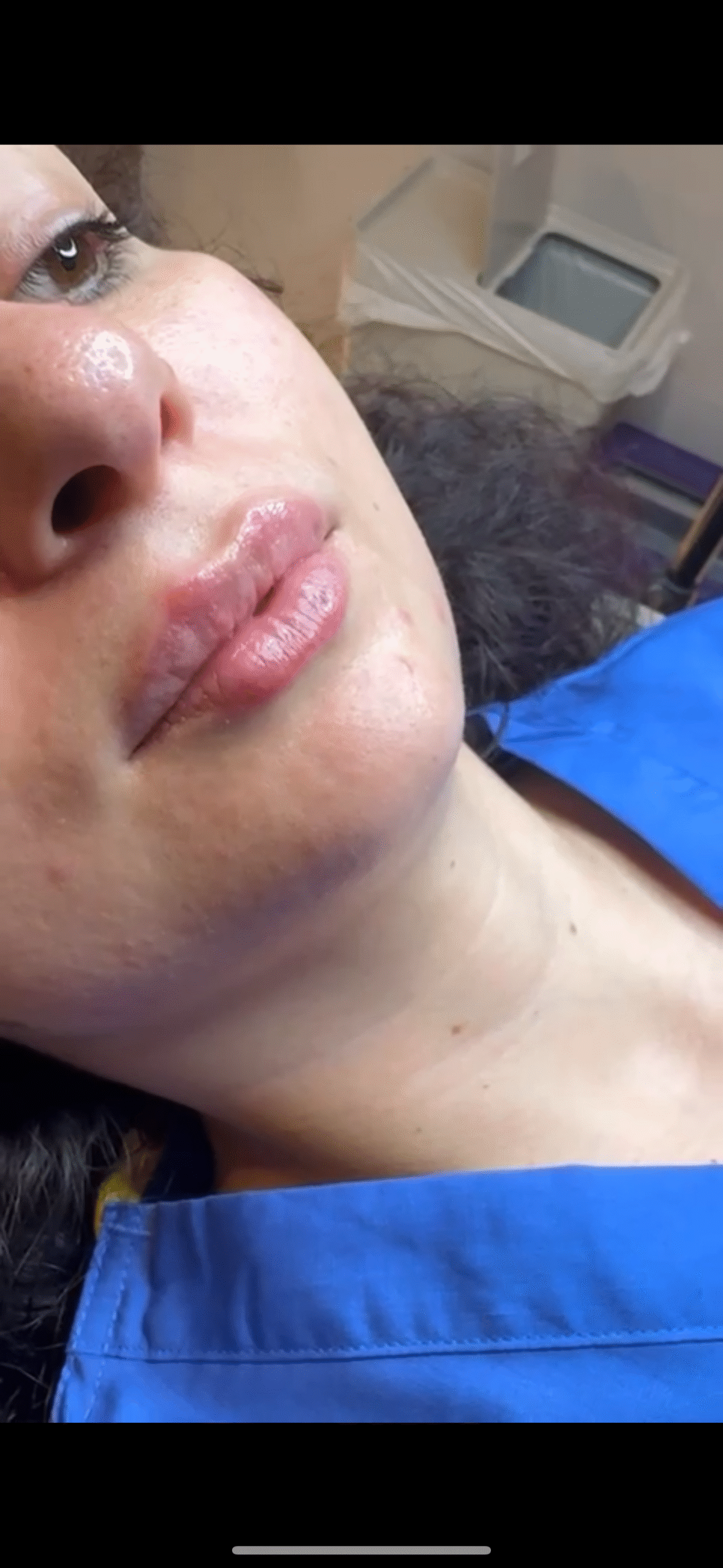 After subtle lip filler treatment showing gentle volume improvement and enhanced lip definition.
