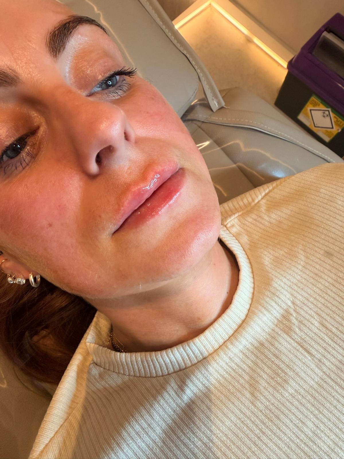 After lip filler treatment at Manchester Aesthetics showing natural-looking lip enhancement and fuller lips.
