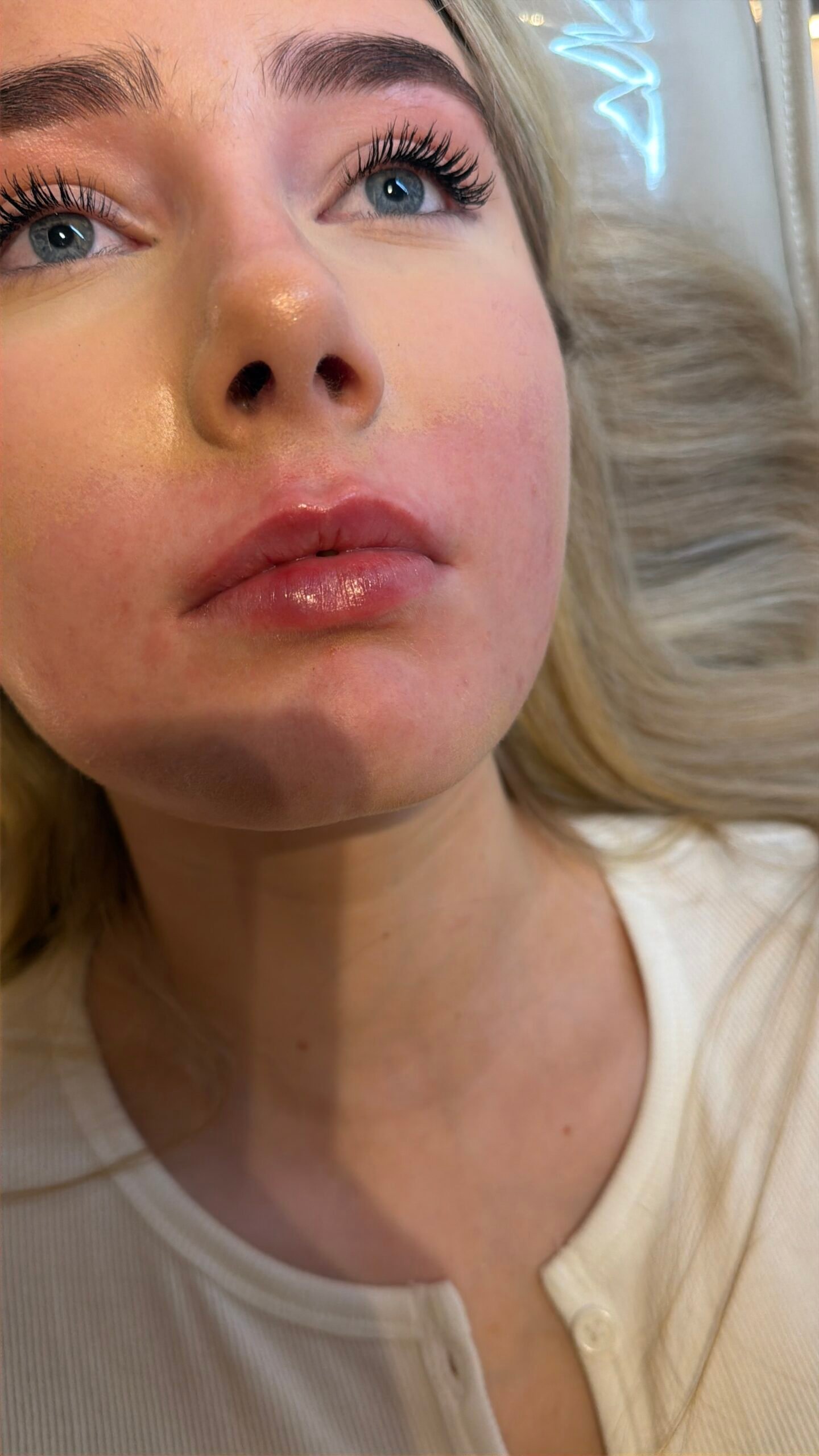 After lip filler in Manchester