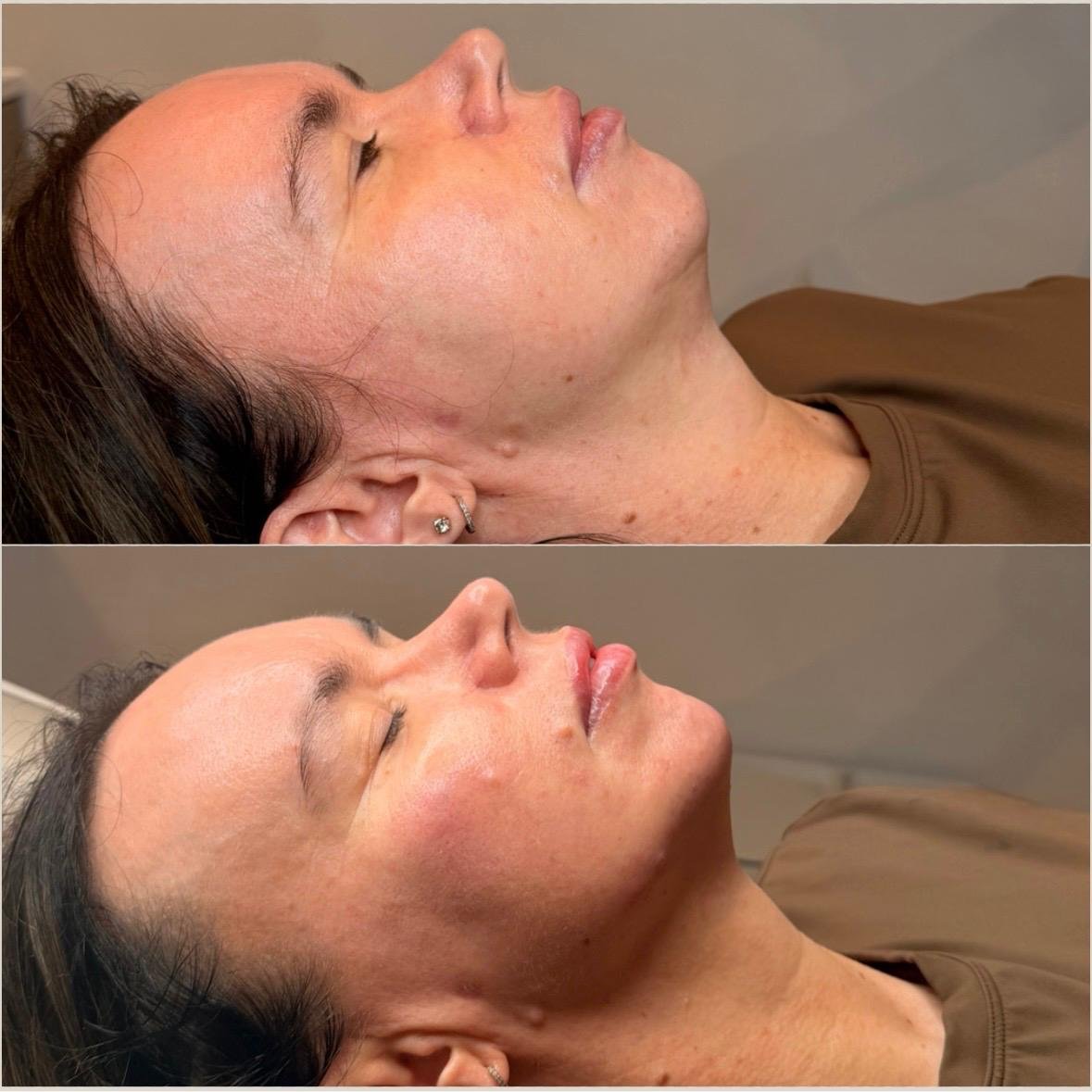 Before and after 4ml filler package treatment showing enhanced facial profile, improved chin projection and natural-looking lower-face contour.