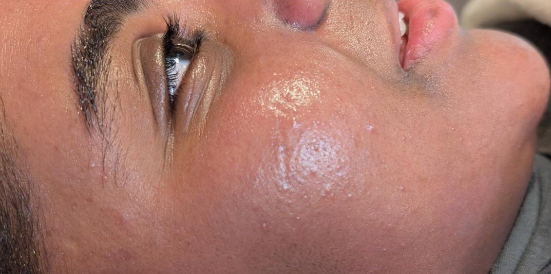 After Obagi Blue Peel Radiance treatment showing brighter-looking skin, smoother texture and a refreshed cheek area.