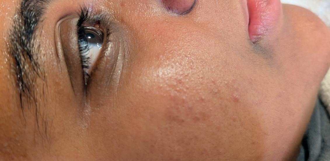 Before Obagi Blue Peel Radiance treatment showing skin texture and cheek area before the peel.