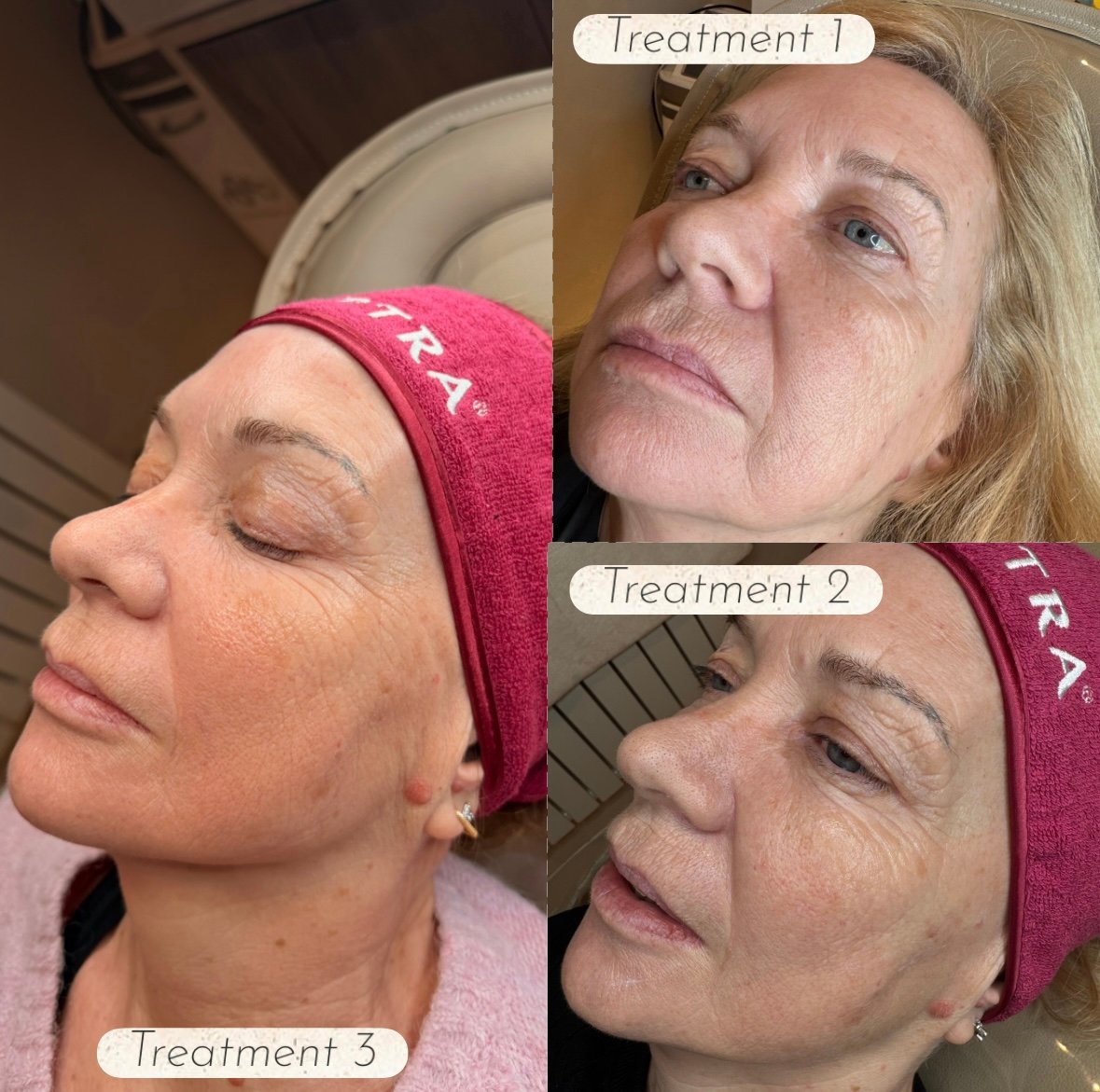 Before and after Sculptra treatment images showing facial rejuvenation results after treatments one, two and three, with improved skin firmness and facial contour.