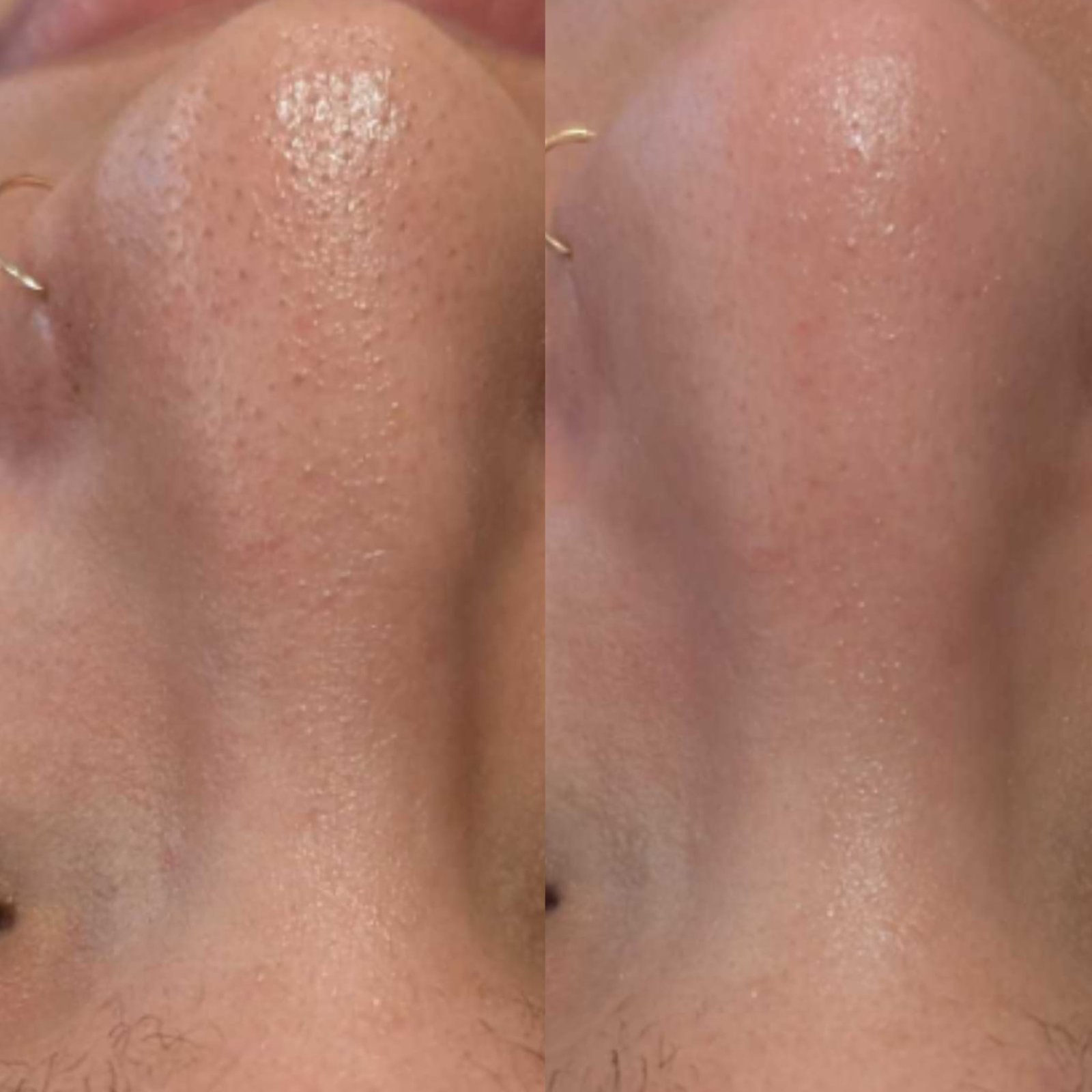Before and after Hydro2 facial treatment showing improved skin texture, clearer pores and a smoother-looking nose area.
