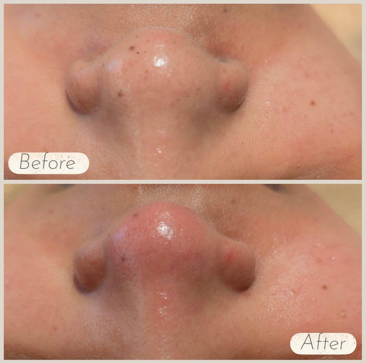 Hydro2 facial before and after images showing the nose area before treatment and after treatment with cleaner-looking pores and refreshed skin.