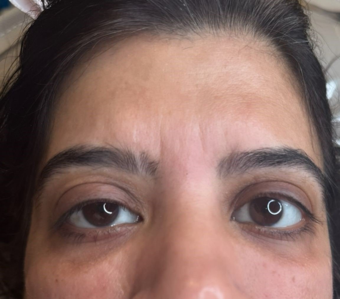 B&A polynucleotides under eye