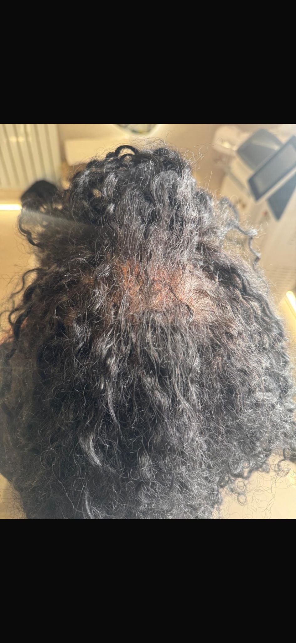 Before PRP hair treatment showing the scalp and hair density before platelet-rich plasma treatment.