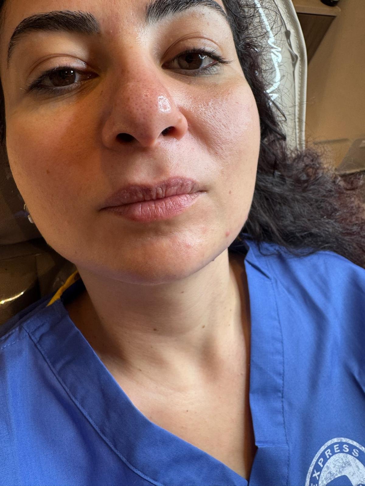 Before subtle lip filler treatment image showing natural lip shape before enhancement.