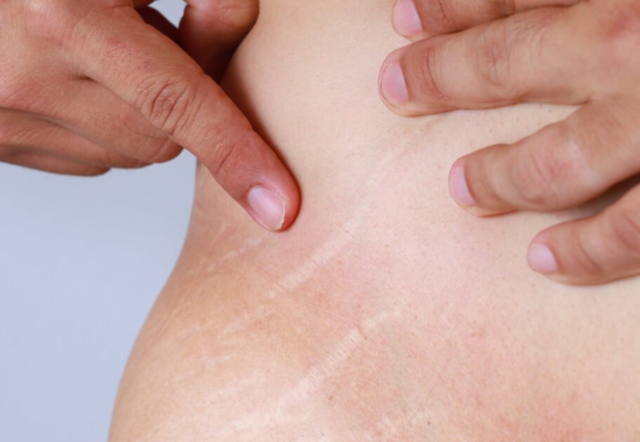 CO2 laser treatment for stretch marks in Manchester