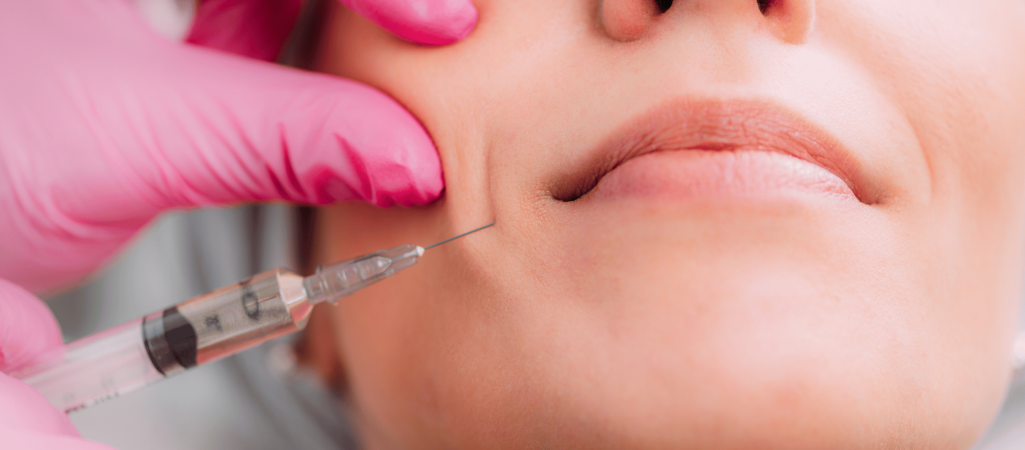 Marionette Lines Filler Treatment