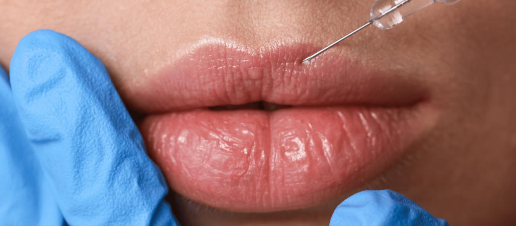 Filler Correction - Dissolved Using Hyalase